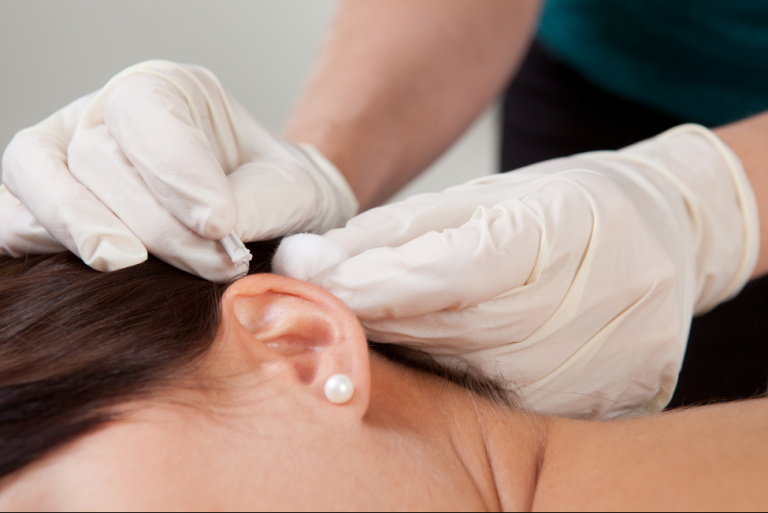 Ear (auricular) acupuncture treatment